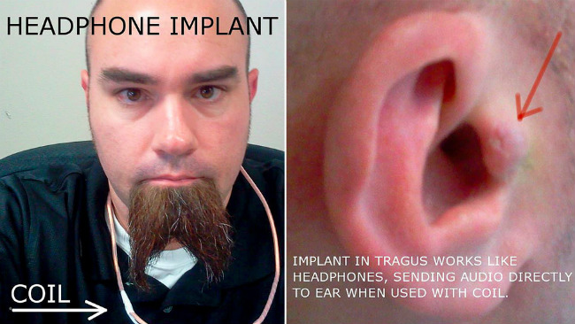 Cansado dos fones de ouvido, homem implanta um fone em sua orelha