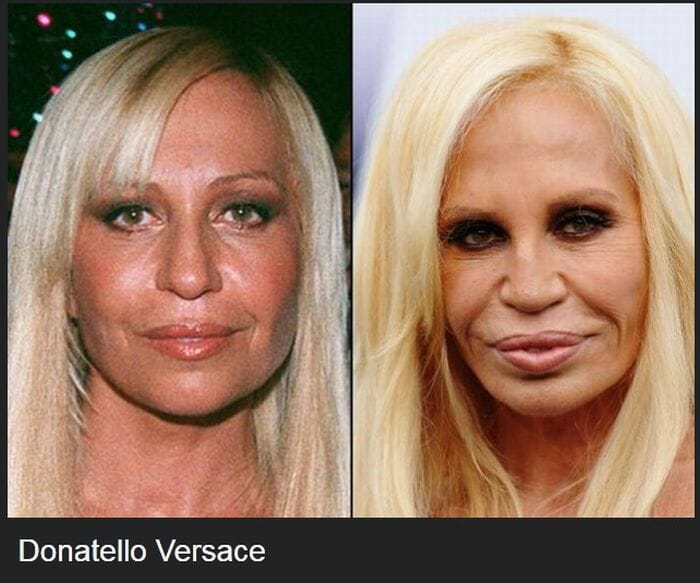 22 Celebridades antes e depois de cirurgias plásticas